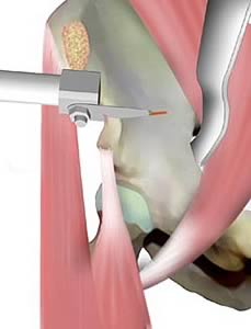 Scie oscillante (pour chirurgie des articulations)