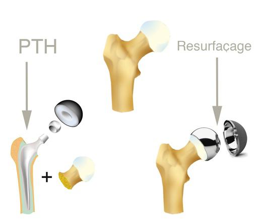 resurfacage difference